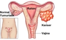 Yumurtalık Hastalıkları Belirtileri ve Tedavisi