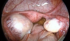 Yumurtalık Kisti Çeşitleri Nelerdir?