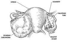 Yumurtalık Tümörü Belirtileri ve Tedavisi